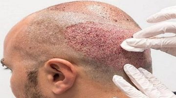 كيفية اختيار أفضل دكتور لزراعة الشعر في مصر - التقرير